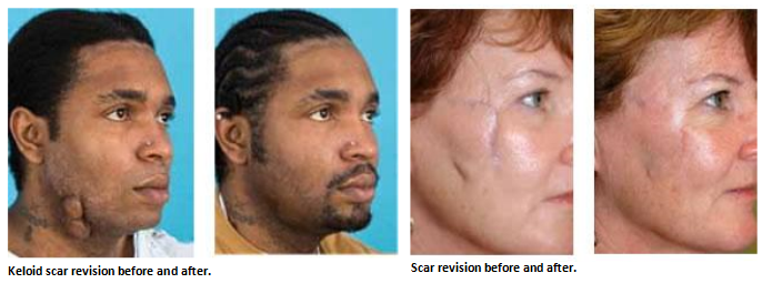 Scar Revision